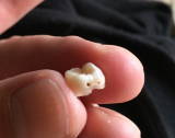 乳歯.JPG